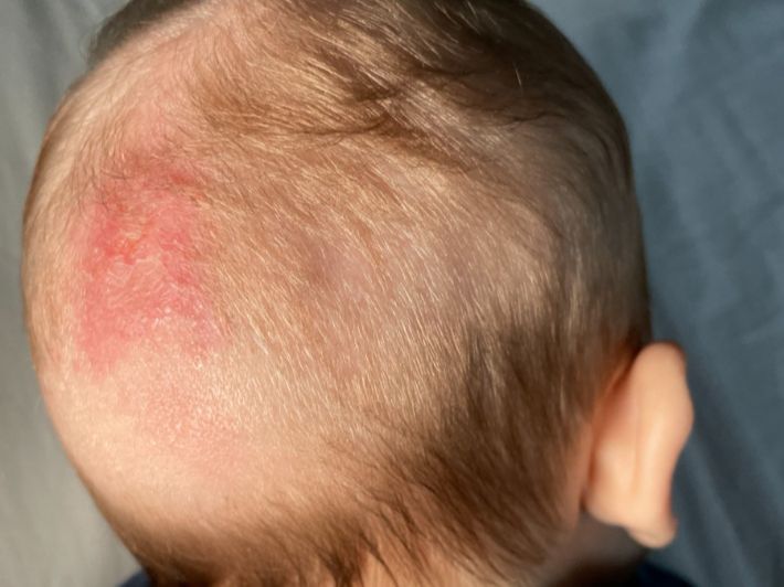 عدوى فطرية تصيب الأطفال، أعراض وطرق علاج تينيا الرأس