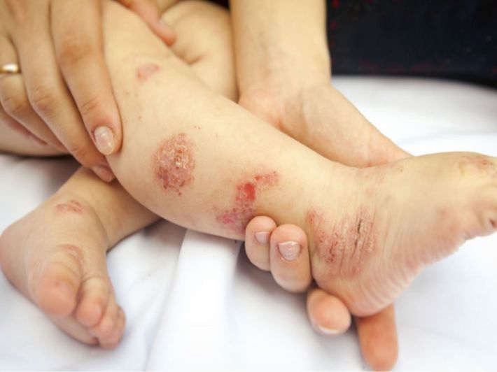 أعراض وطرق علاج الأكزيما لدي الأطفال