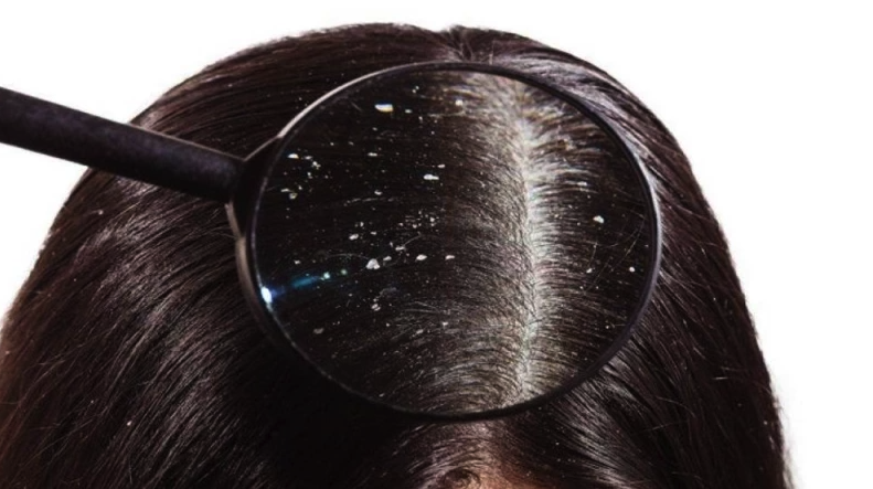 وصفة الحلبة والزبادى تخلصك من قشرة الشعر