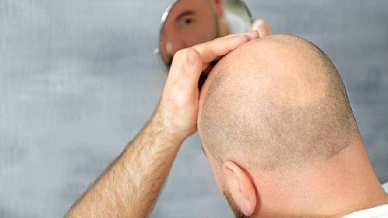 دراسة: الرجل الأصلع أكثر جاذبية في عيون النساء من صاحب العيون الزرقاء