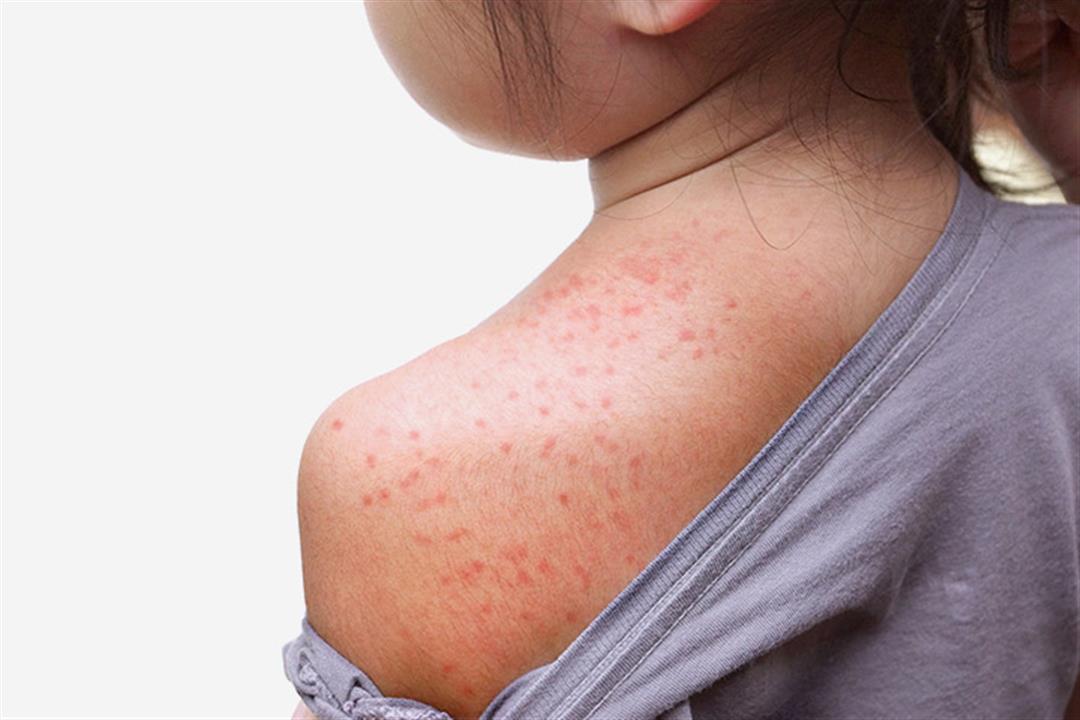 حمو النيل لدى الأطفال، أسبابه وطرق علاجه والوقاية منه