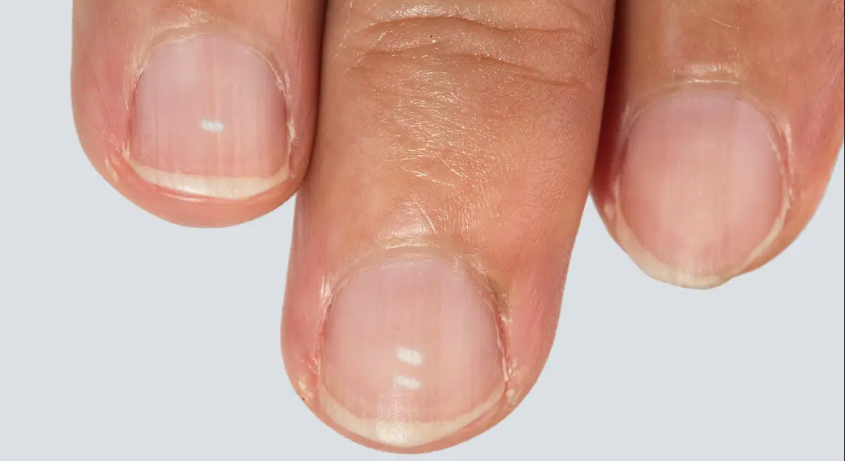 طرق للوقاية من ظهور البقع البيضاء على الأظافر