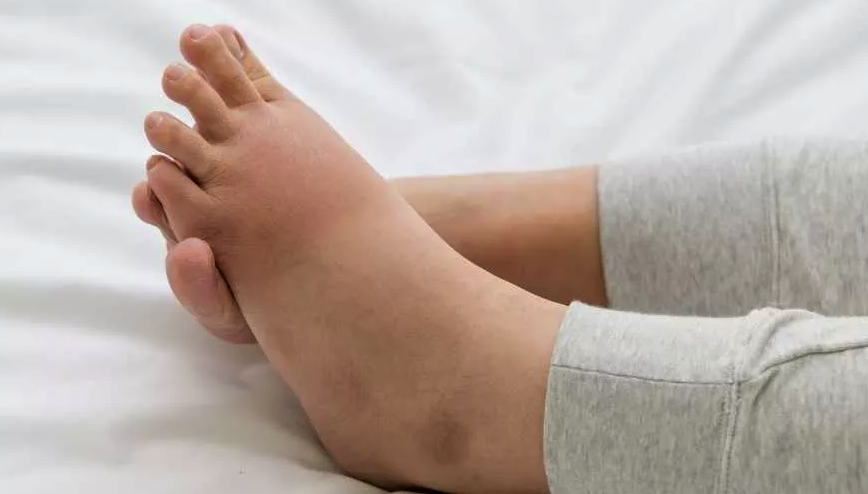 نصائح عملية لتجنب تورم الساقين بدون أدوية