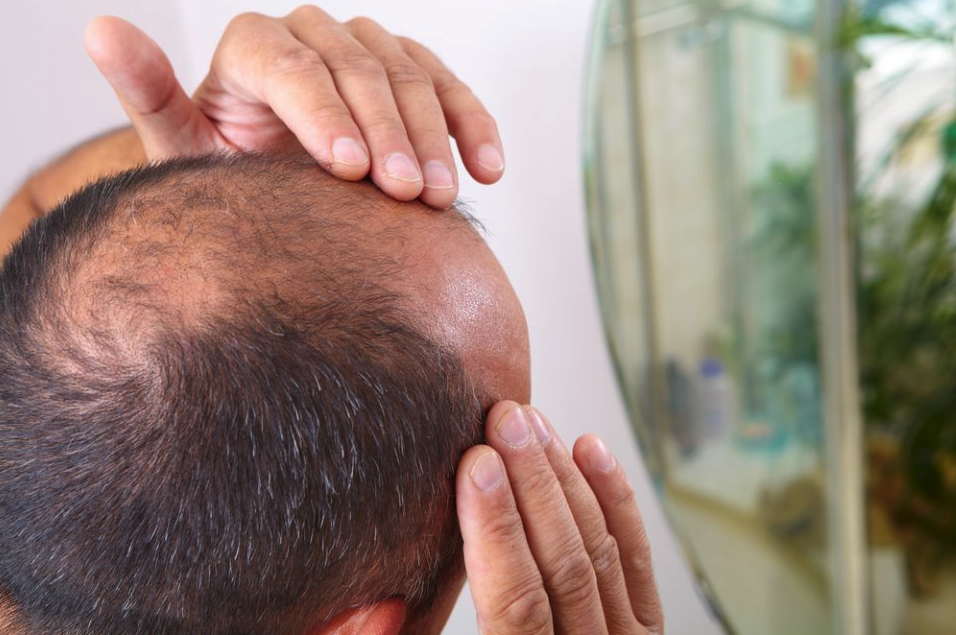 دراسة: علاج جديد للصلع لدى الرجال يُظهر نتائج واعدة خلال عام